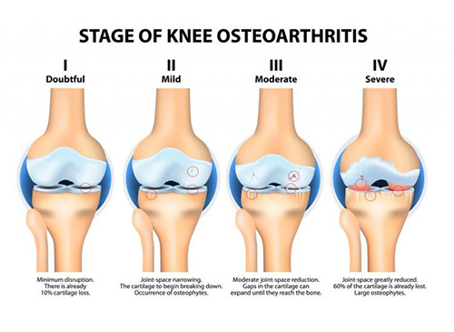 Knee-Osteoarthritis-OA-1024x536