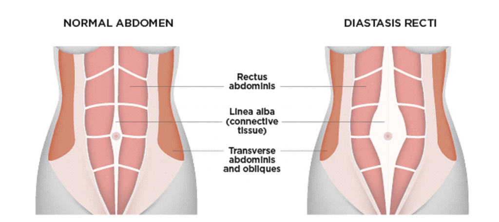 diastasis-1024x457
